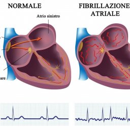 La fibrillazione atriale è un disturbo del battito